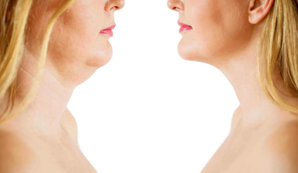 Double Chin treatment Kingstanding before and after results