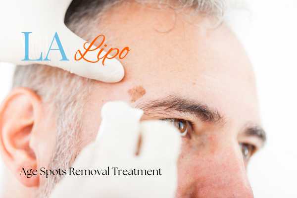 What Are the Most Effective Treatments for Age Spots Kingstanding?