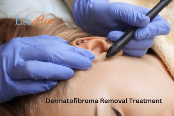 Dermatofibroma Removal Treatment Kingstanding