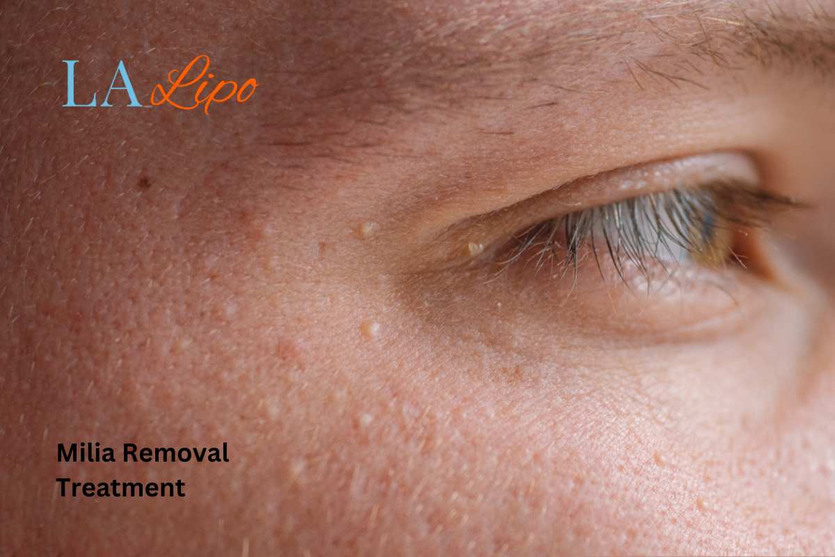 Cryopen Milia Removal: Is It the Easiest and Safest Option Kingstanding?