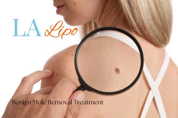 Woman having her inspection of blemish before mole removal Kingstanding
