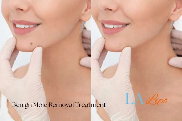 Before and after mole removal Kingstanding treatment