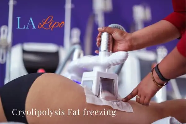 women getting fat freezing Kingstanding