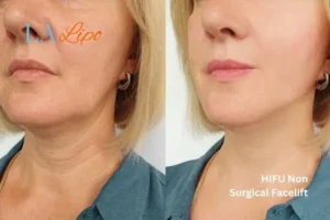hi-fu for wrinkles Kingstanding before and after results