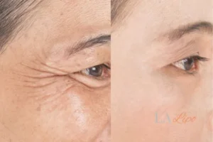 Before and after results of woman - HI-fu wrinkles reduction treatment Kingstanding