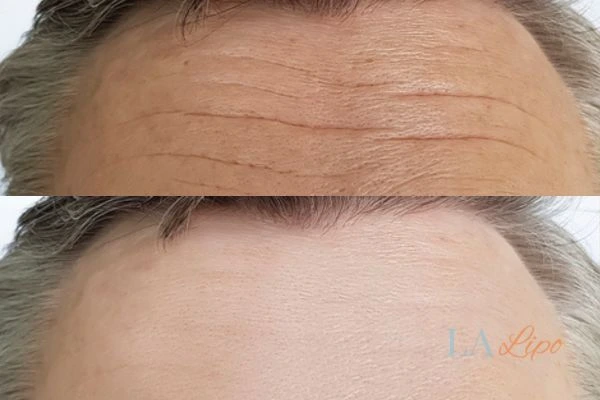 results of HIFU Kingstanding on mans forehead to help reduce lines and wrinkles