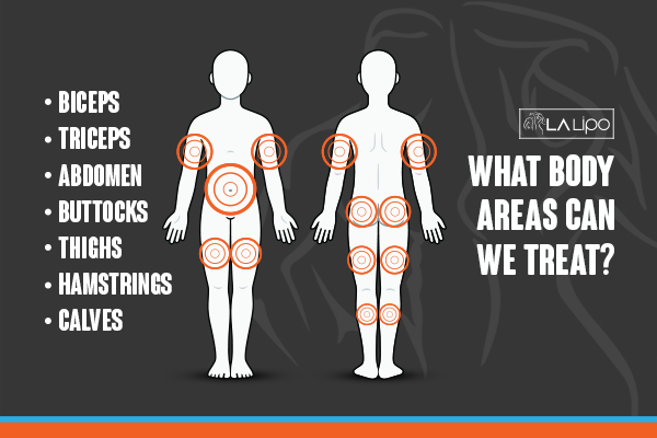 Graphic to show areas you can have LA-EMS Body Sculpting Kingstanding treatment.