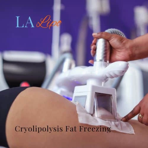 fat freezing - Cryolipolysis Kingstanding