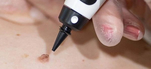 skin tag removal using cryopen Kingstanding
