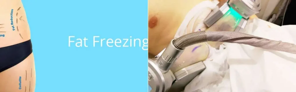 Fat freezing Kingstanding on multiple areas of the body