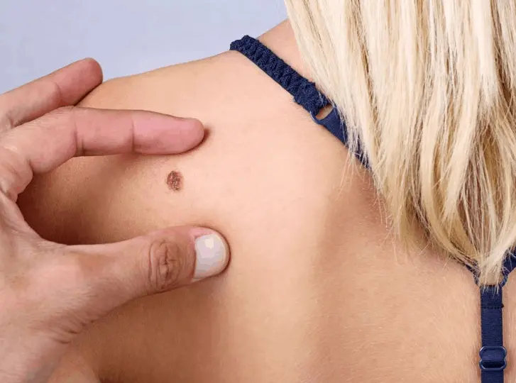 woman having mole removal Kingstanding consultation before treatment.