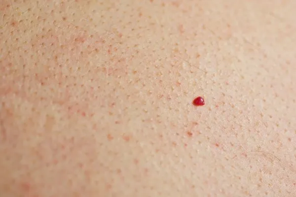 close up of a cherry angioma Kingstanding
