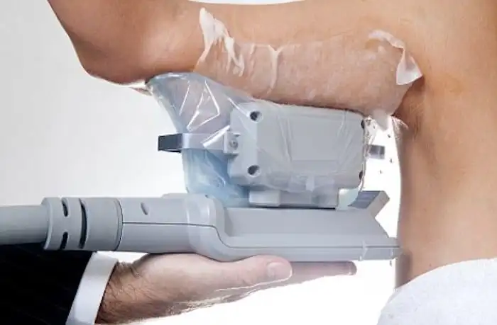 Picture of fat freezing Kingstanding on the upper arms.