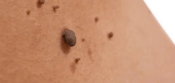 image of a skin tag Kingstanding