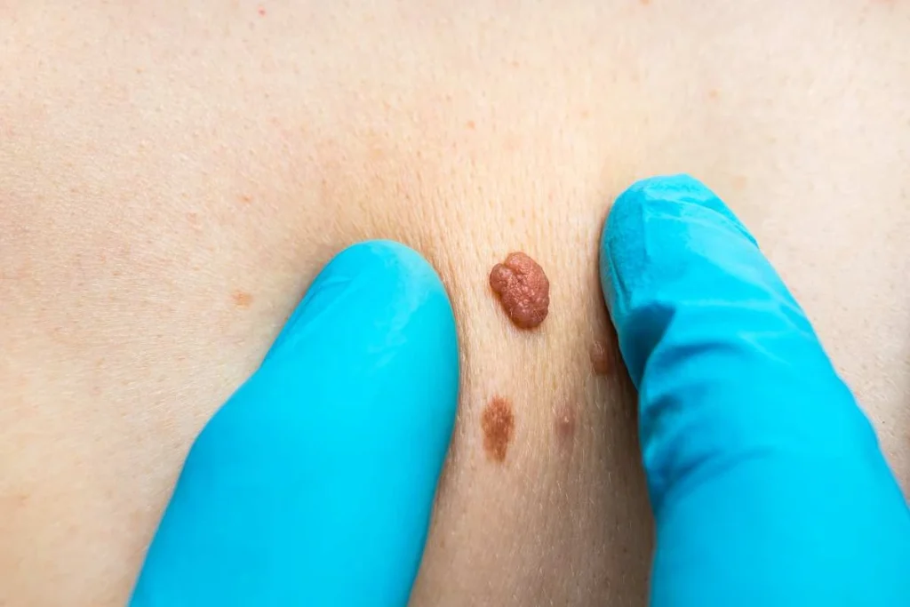 Consultant examining a skin tag Kingstanding