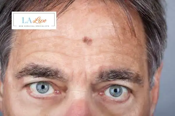 Solar Lentigo Removal Kingstanding image of man with mark on his forehead