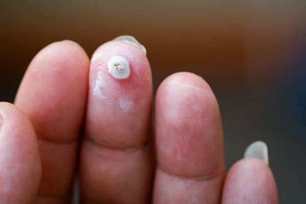 wart on person finger - cryotherapy to treat from LA LIPO Kingstanding