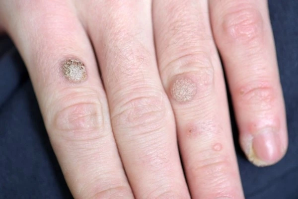 photo of warts on person hand - see wart removal Kingstanding from LA LIPO