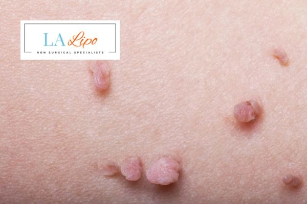 Does cryopen skin tag removal Kingstanding hurt? Find out now call our team today!