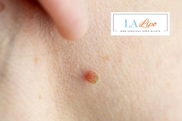 Book skin tag removal Kingstanding today speak to our team now!