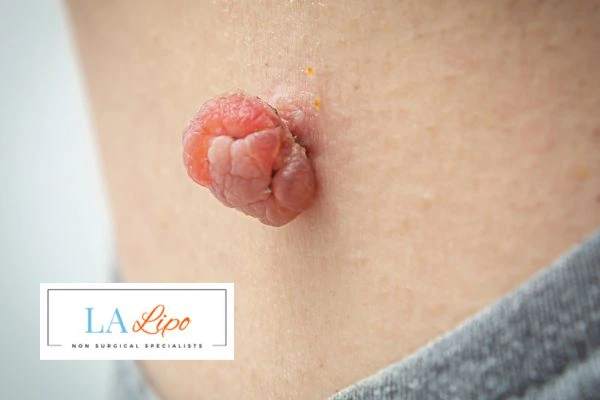 Interested in skin tag removal Kingstanding? Concerned about the pain? Find out more today!
