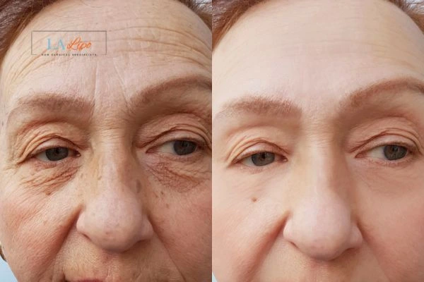 The powerful benefits of Morpheus8 Treatment Kingstanding - Call Our team today!