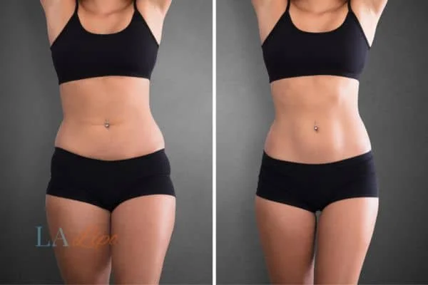 before and after results of non-surgical treatment to help a woman's body image and mental health Kingstanding