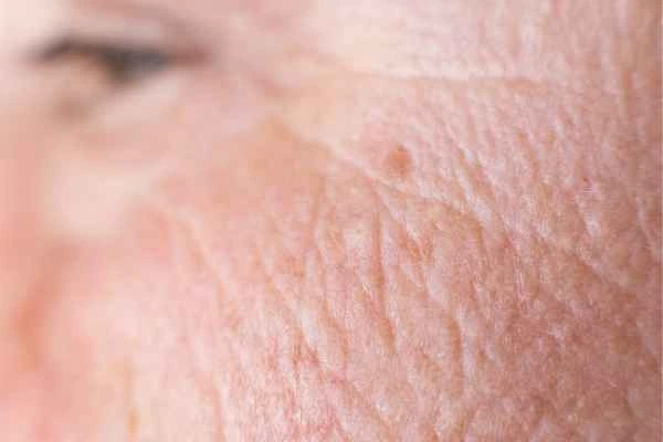 close up picture of a woman's face showing an age spot Kingstanding