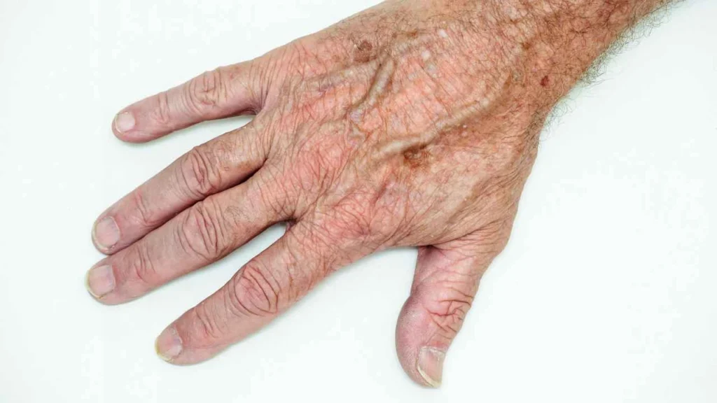 Male hand showing age spot Kingstanding