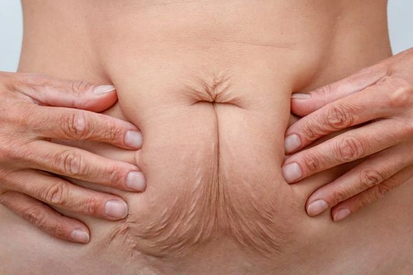 Image of a woman's stomach with loose skin - example of skin tightening Kingstanding options
