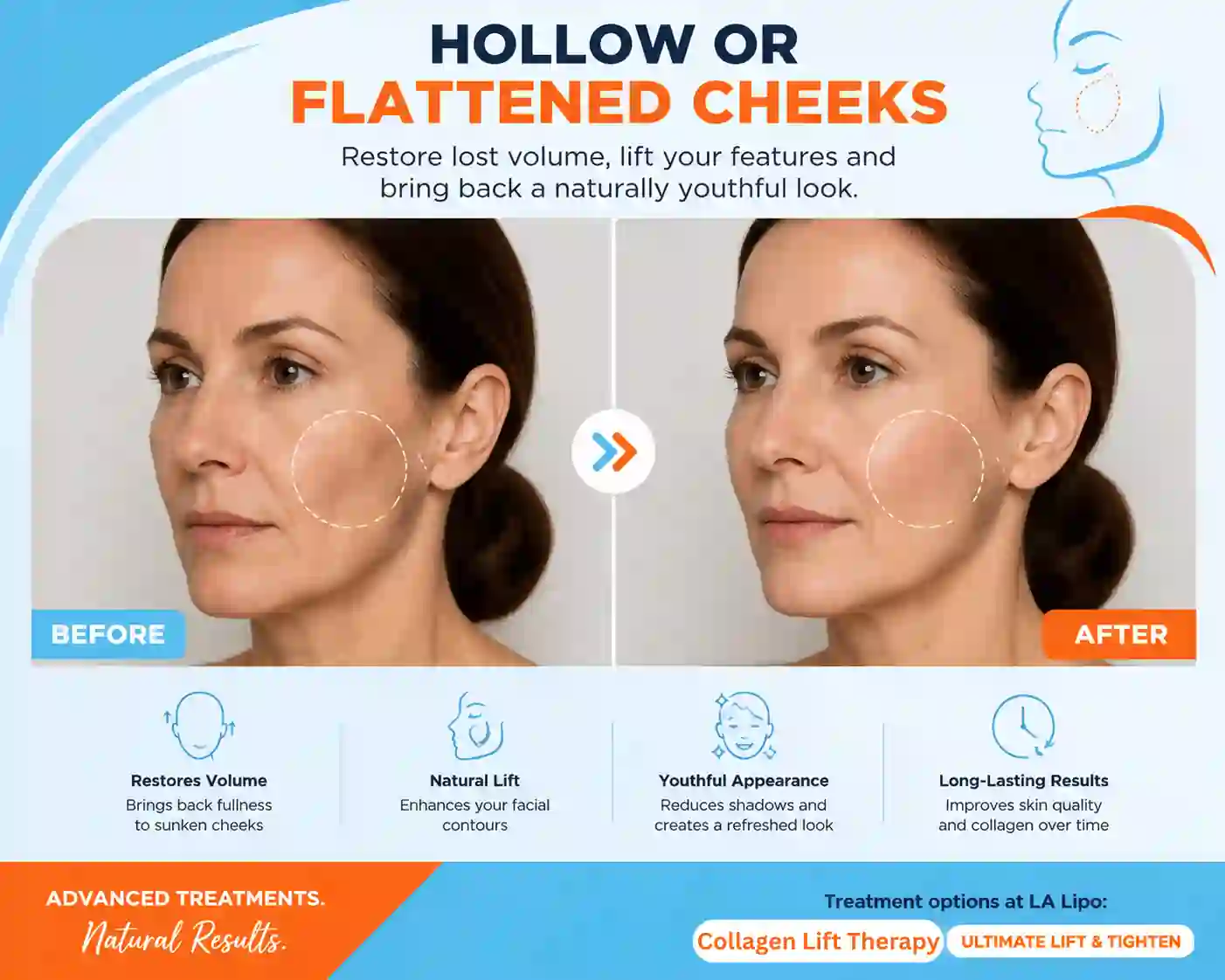 Sign #4: Hollow or Flattened Cheeks Kingstanding