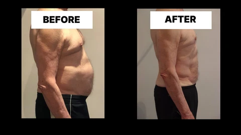 What Symptoms Can Diastasis Recti Cause in Men? Weak Core, Back Pain and Poor Posture Kingstanding